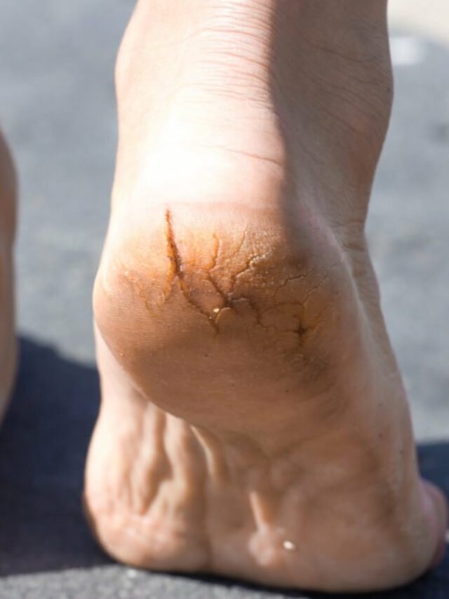 Macro photo pair of cracked heels. Male back view.