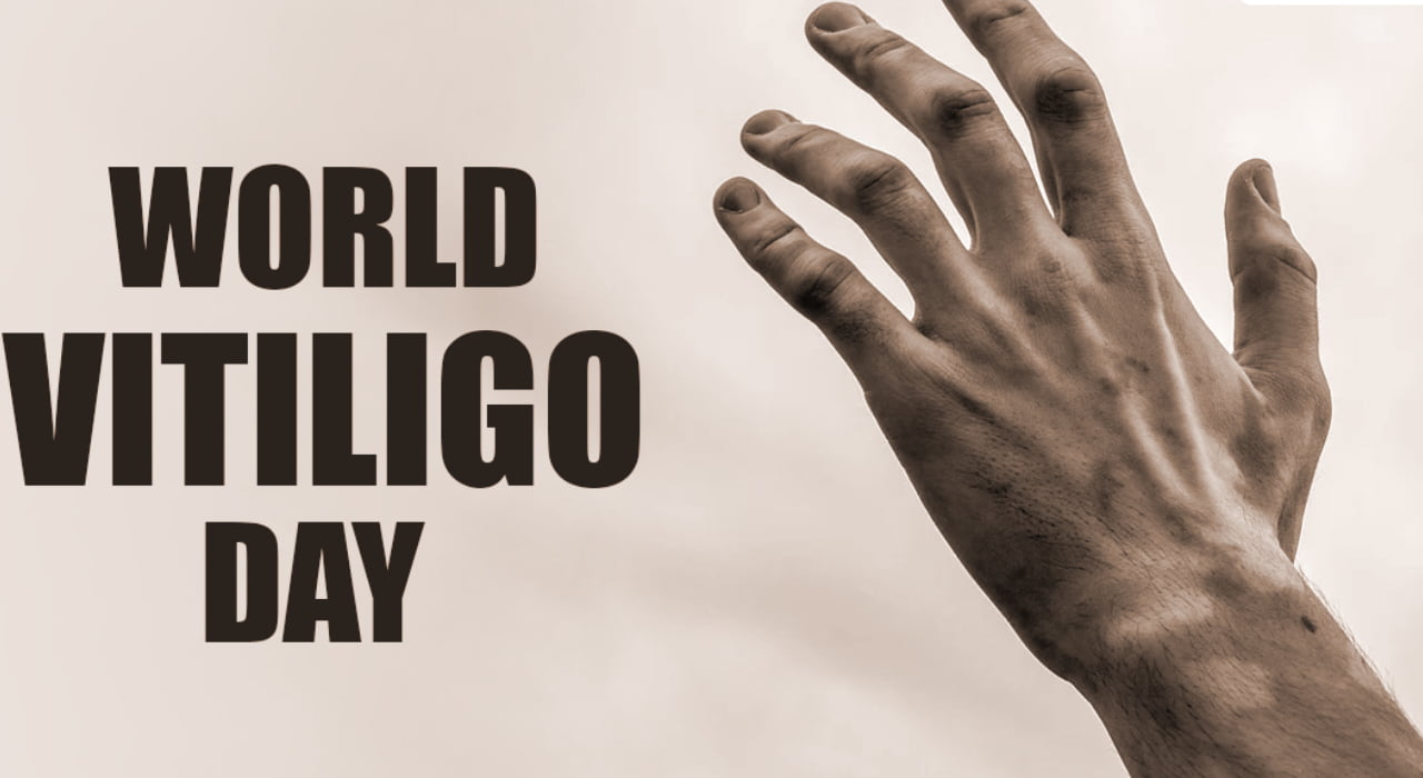 Vitiligo