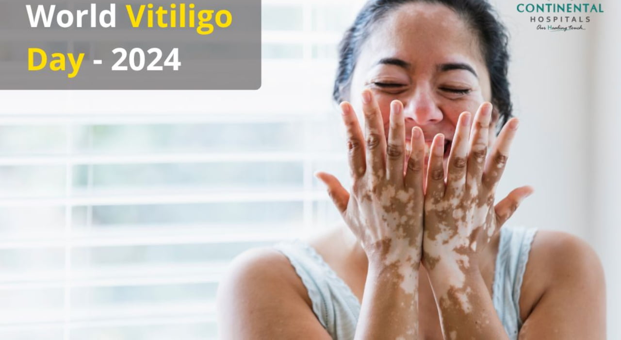 உலக வெண்புள்ளி நோய் தினம்: வரலாறு, முக்கியத்துவம் மற்றும் சிறப்புகள் இதோ…