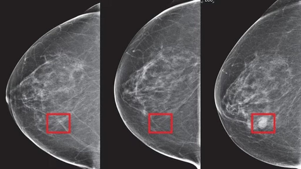 breast cancer