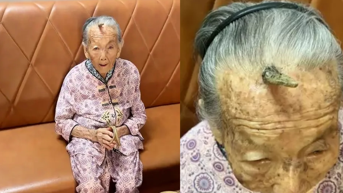 horn in 107 year old woman head